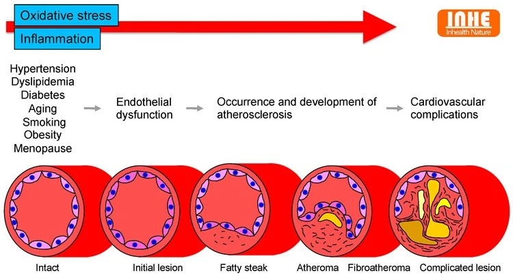 Causes of Atherosclerosis Causes of Atherosclerosis
